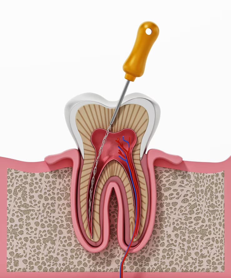 Endodontics with Microscope