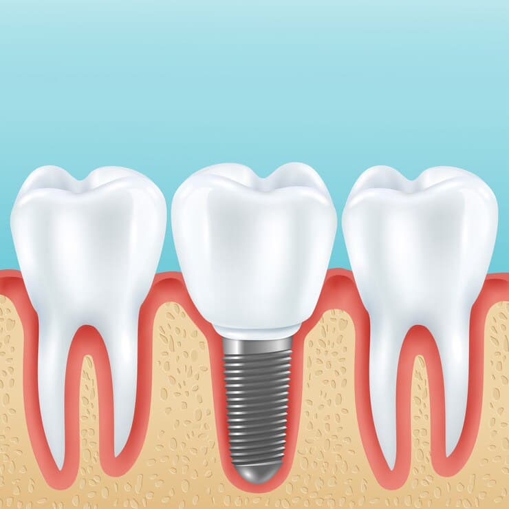 implant