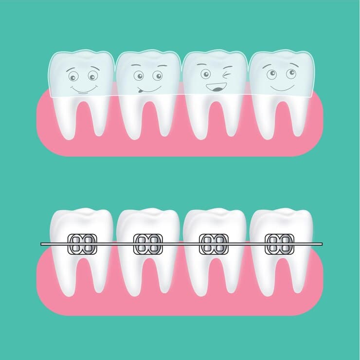 Orthodontics and Aligners